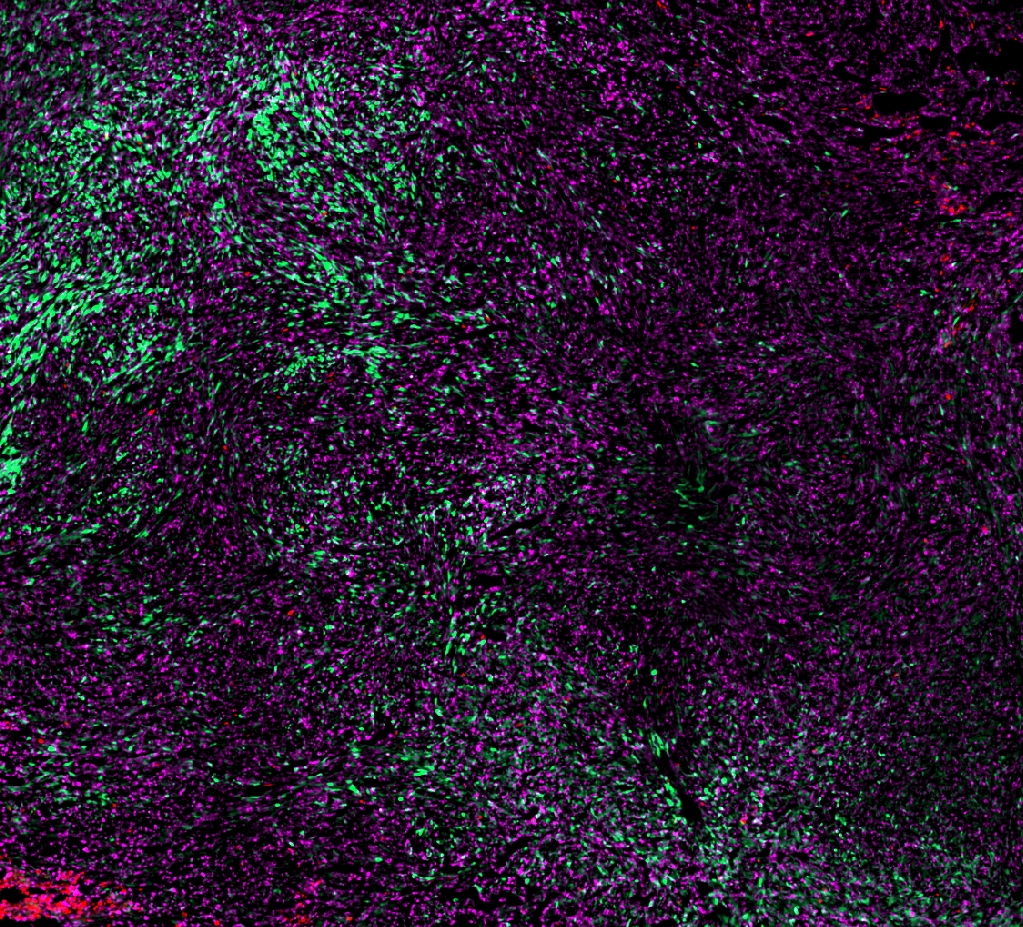 Magnified view of a tumor